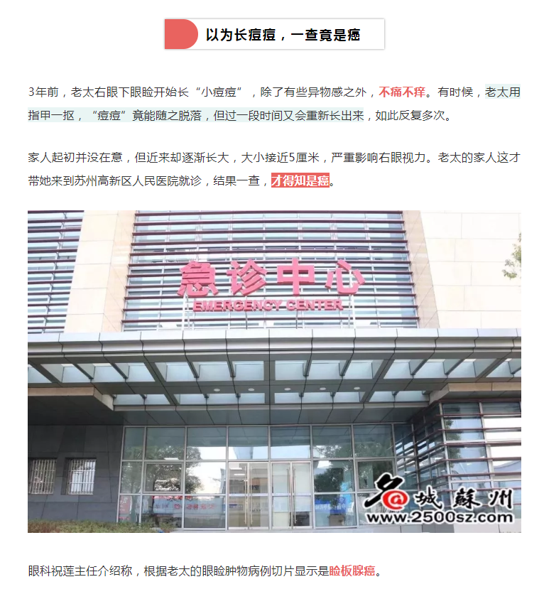睑板腺癌患者治疗，名城苏州，20190704.png