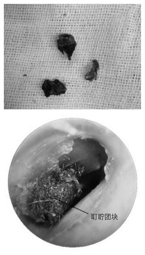 外耳道胆脂瘤取出图片图片